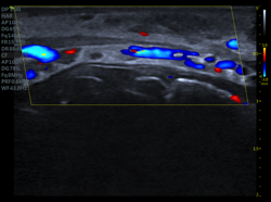 ultrasound filler lips